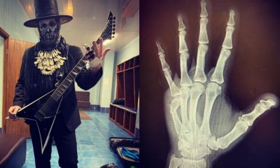Limp Bizkit guitarist broken hand