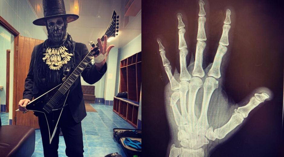 Limp Bizkit guitarist broken hand