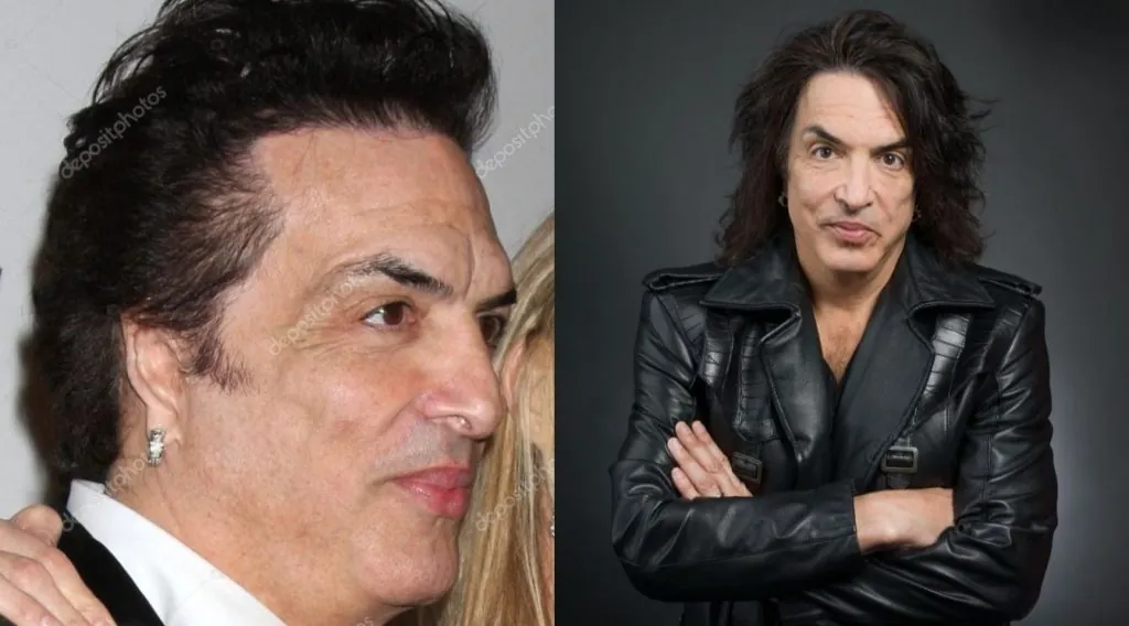 Paul Stanley ear malformation